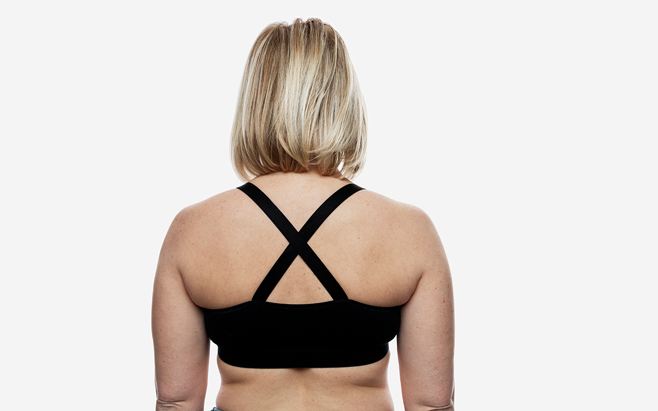 Pourquoi un lifting du dos est-il nécessaire après une sleeve